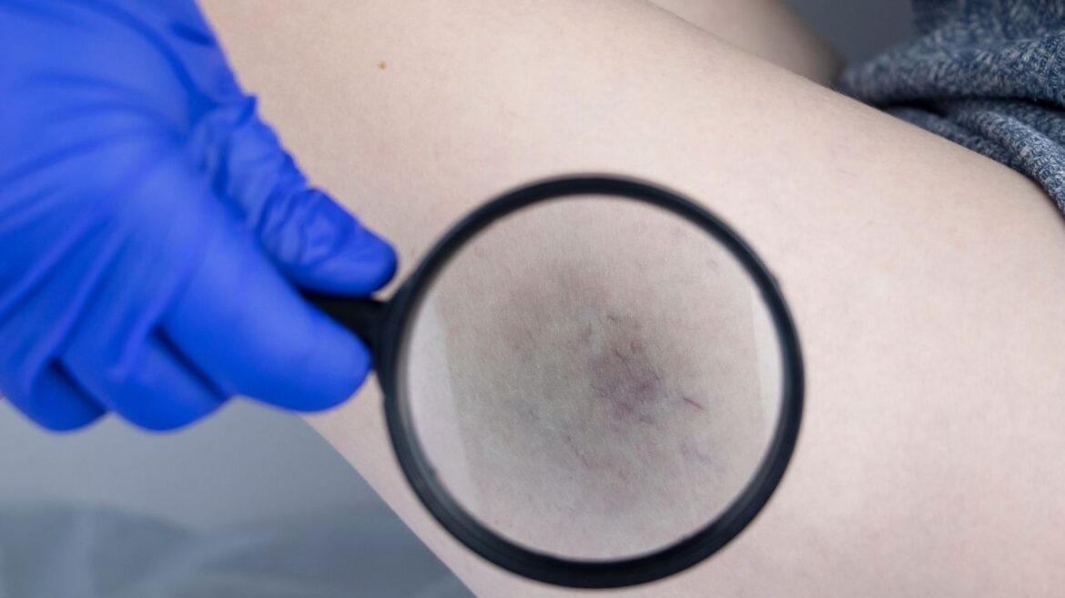 Promienie laserowe – nowoczesny sposób na zamykanie naczynek i zadbanie o bezpieczną skórę