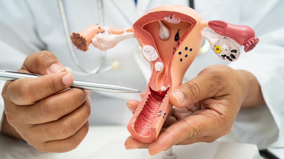 Mięśniaki macicy – objawy i metody leczenia